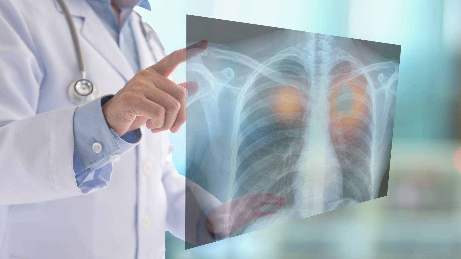 Doctor holding lung cancer X-ray